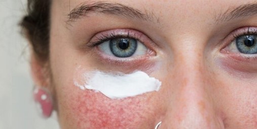 Las razones de la formación de piel inflamatoria con tendencia al acné.