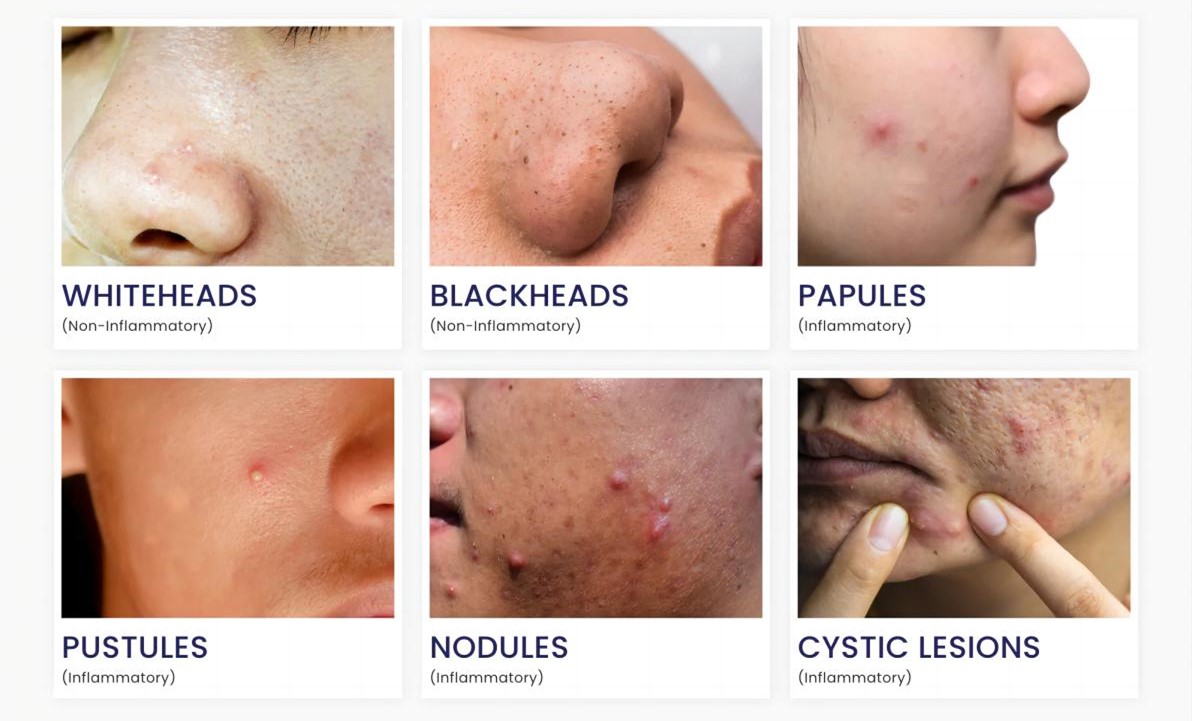 Las razones de la formación de piel inflamatoria con tendencia al acné.
