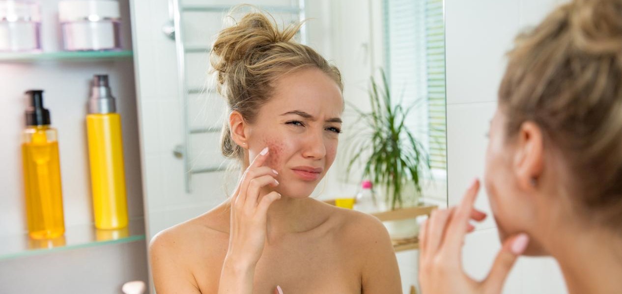 The reasons of inflammatory acne-prone skin formation