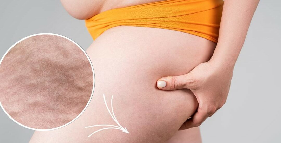 Do you also struggle with Cellulite?