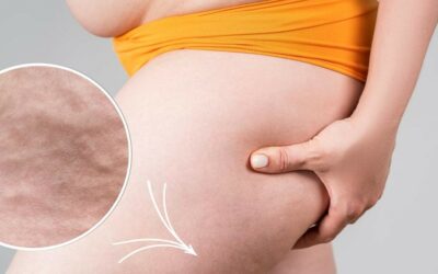 Do you also struggle with Cellulite?