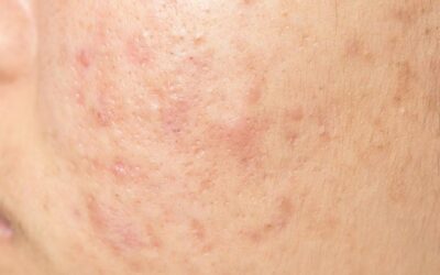 Tratamiento de las cicatrices del acné: una guía completa para comprender, prevenir y tratar las cicatrices