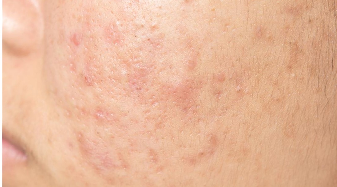 Acne Scars Treatment: A Comprehensive Guide to Understanding, Preventing, and Treating Scarring