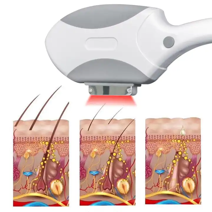 Popular Professional OPT Hair Removal Machine